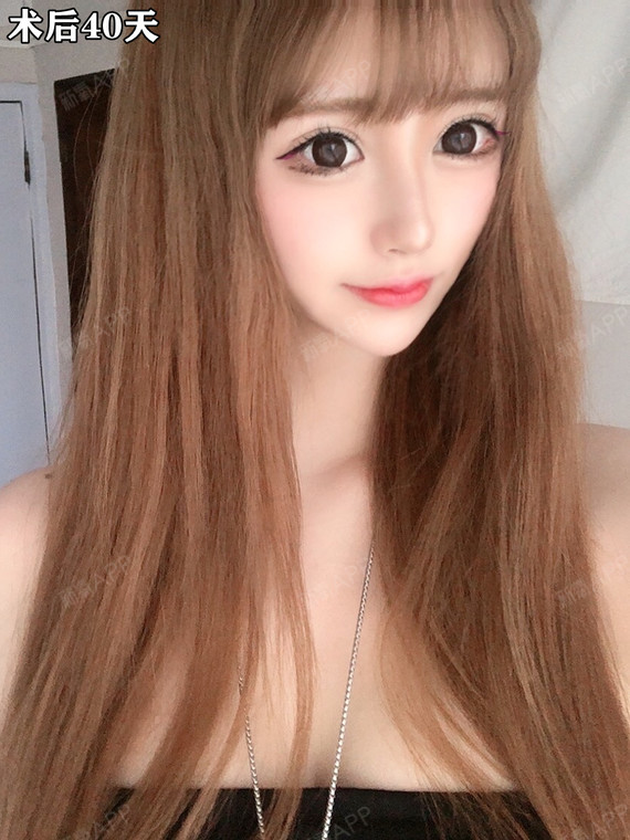 重睑术在现代社会_圈子-新氧美容整形