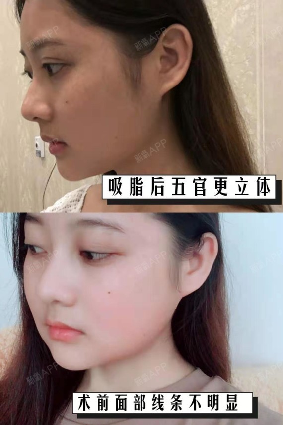 面颊吸脂,再进行轮廓塑造,采用耳后进针的方式,这样低创且不留疤痕