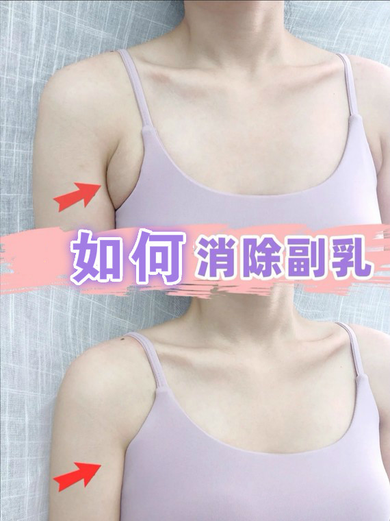 副乳的冷知识,你必须要了解