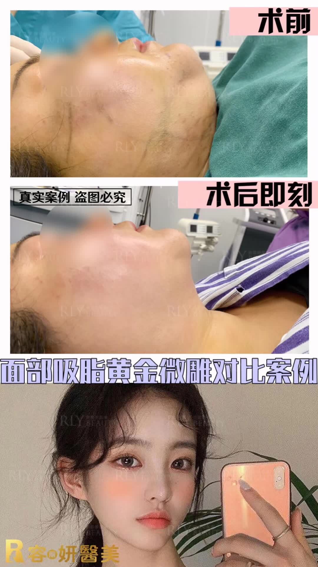 面颊吸脂黄金微雕术后即刻