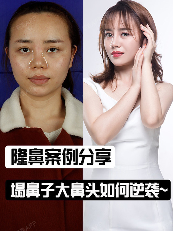 塌鼻子大鼻头如何逆袭