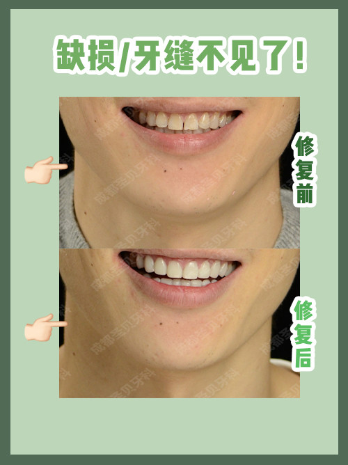 瓜子牙影响颜值!修复之后帅哥的笑容太杀我了!