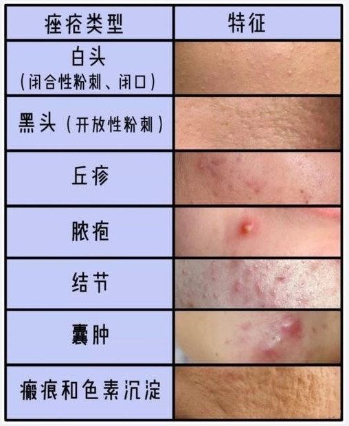 痤疮有几种类型?一,黑头粉刺:由于过多的皮质分泌,_圈子-新氧美容整形