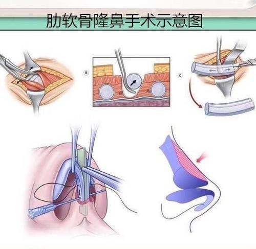 肋骨鼻修复,还需要重新取肋骨吗?