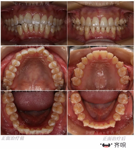 牙齿咬合过深,门牙外翻,从不敢笑!现在的她却赢在"嘴"上!