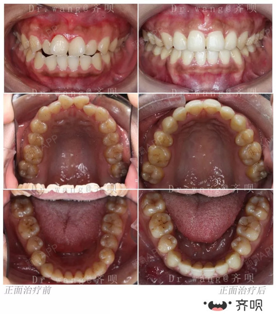 咬合对刃,牙齿参差不齐,下颌后缩,她选择矫正改写人生!