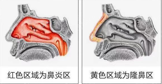 鼻炎是鼻腔粘膜和粘膜下组织的炎症,而隆鼻手术是在鼻骨上进行,并不会