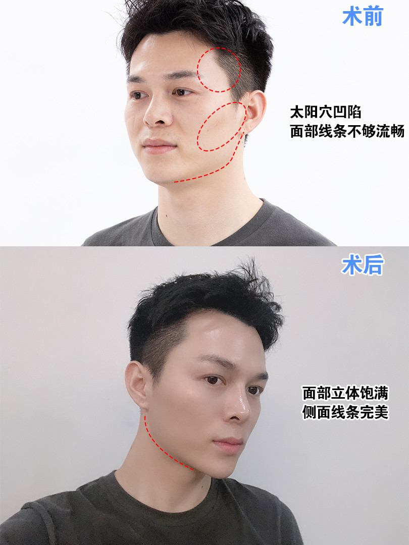 术前缺陷:太阳穴凹陷,面部线条不够流畅