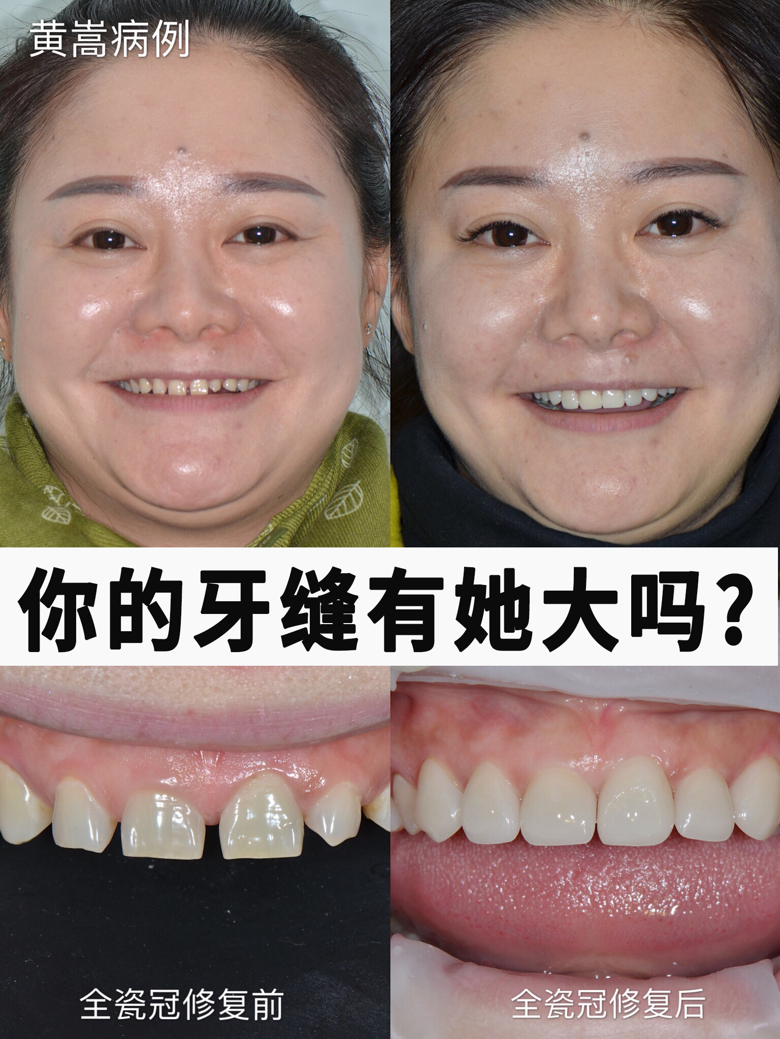 今日一组【全瓷冠修复过小牙 大牙缝】案例分享