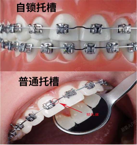 自锁托槽和普通托槽的区别牙齿矫正有托槽矫正和隐形矫_圈子-新氧美容