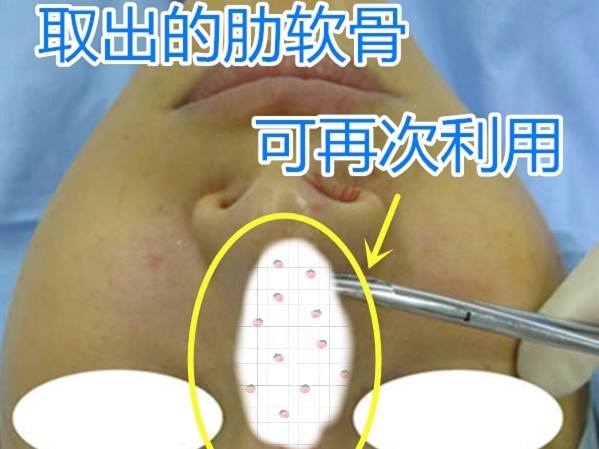 肋骨鼻做修复,还可以再去肋软骨吗?