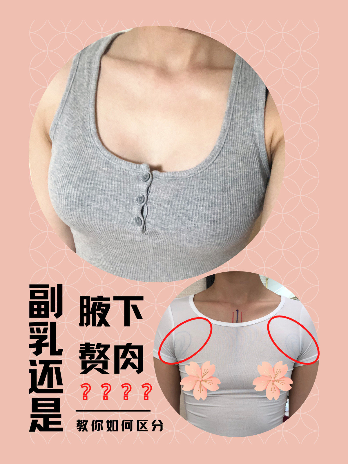 副乳还是腋下赘肉?教你如何区分