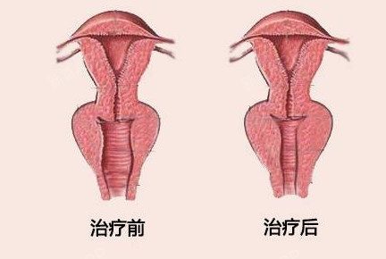 以前缩阴手术方法有双坏,肛提肌缝合法等,但这种手术