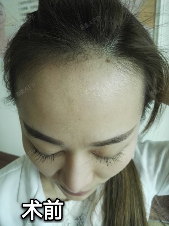 女性发际线高,前额头发少是_圈子-新氧美容整形