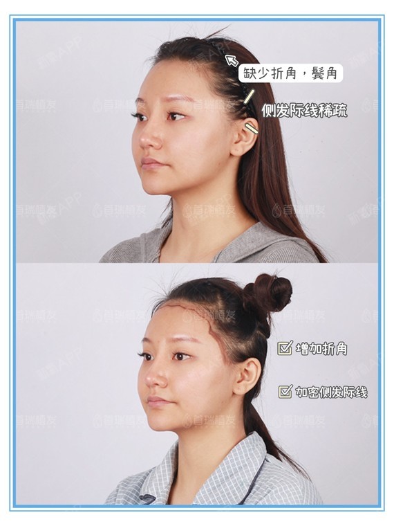 子怡额头较为饱满,缺少折角,侧发际线和鬓角