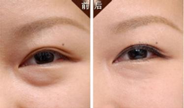 手术去眼袋会反弹吗,手术去眼袋能管几年看看李姐坚持记录的变化