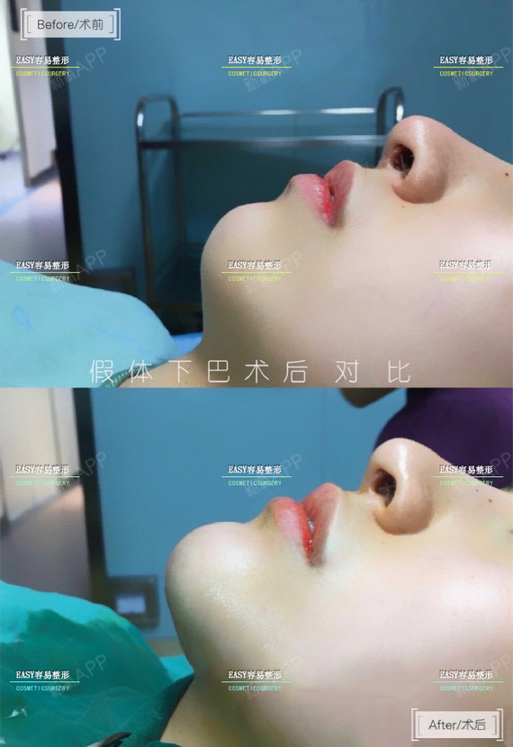 【硅胶垫下巴】韩士生科多点定位假体丰下巴 韩式生科假体 可升立秀