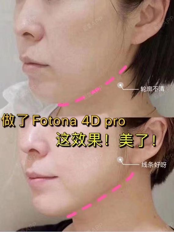 说体验了一次很火的欧洲之星fotona 4d pro,但是术后效果也就那样,没