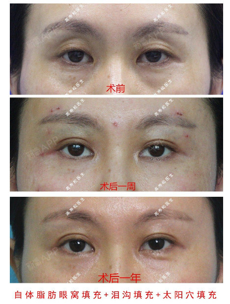 所长不推荐大家用玻尿酸填充,因为层次一旦掌握不好,很容易出现丁达尔