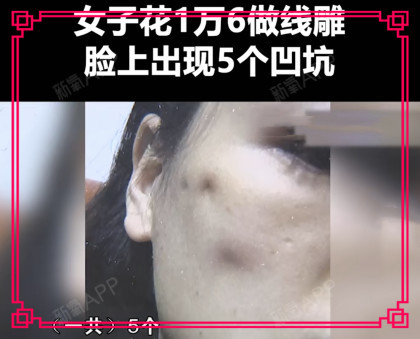 平心而论,任何人做美容都是为了变美,那线雕后脸上有凹坑是谁都不想
