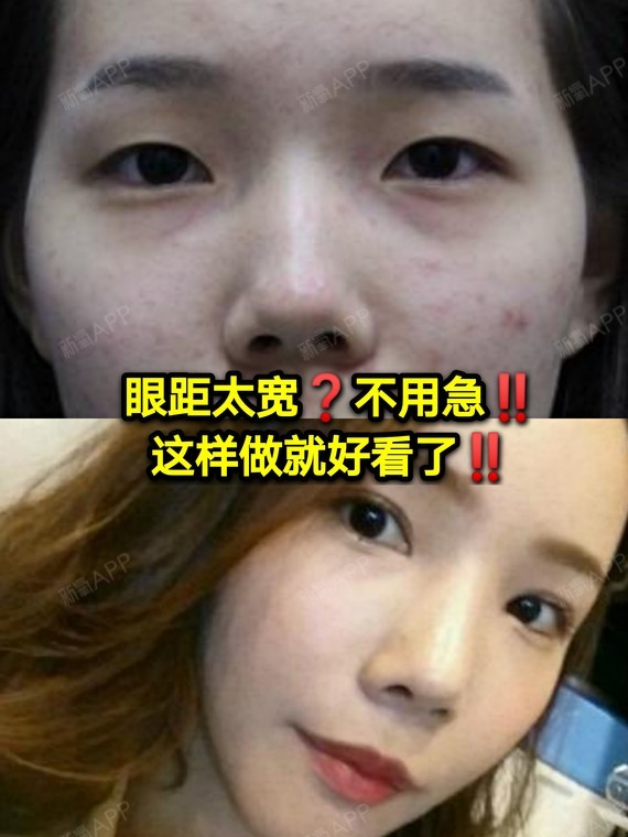 眼距太宽?不用急!
