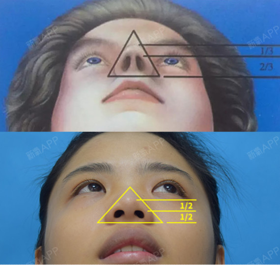 由于亚裔人种的鼻梁大多偏低,鼻中隔和鼻小柱发育不良,所以会导致因