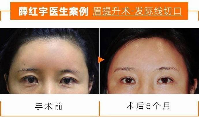 患者术前眉压眼