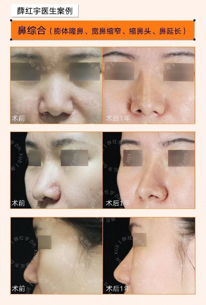 患者初鼻基础差,山根低平,鼻背宽,鼻头鼻翼肥大,鼻