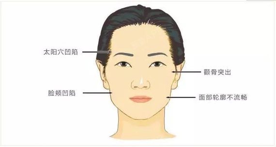 颧骨颧弓是如何影响脸型的?