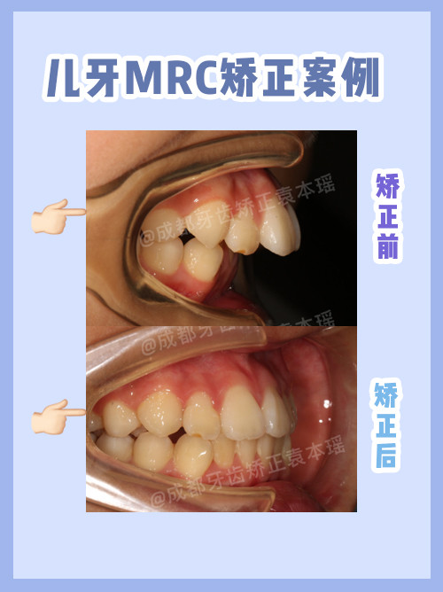 矫正要趁早,换牙期三个月mrc矫正效果惊人