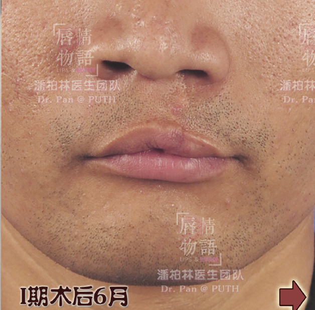 男,25岁,先天性左侧唇裂,幼儿期进行首次修复后,成年仍遗留白唇瘢痕