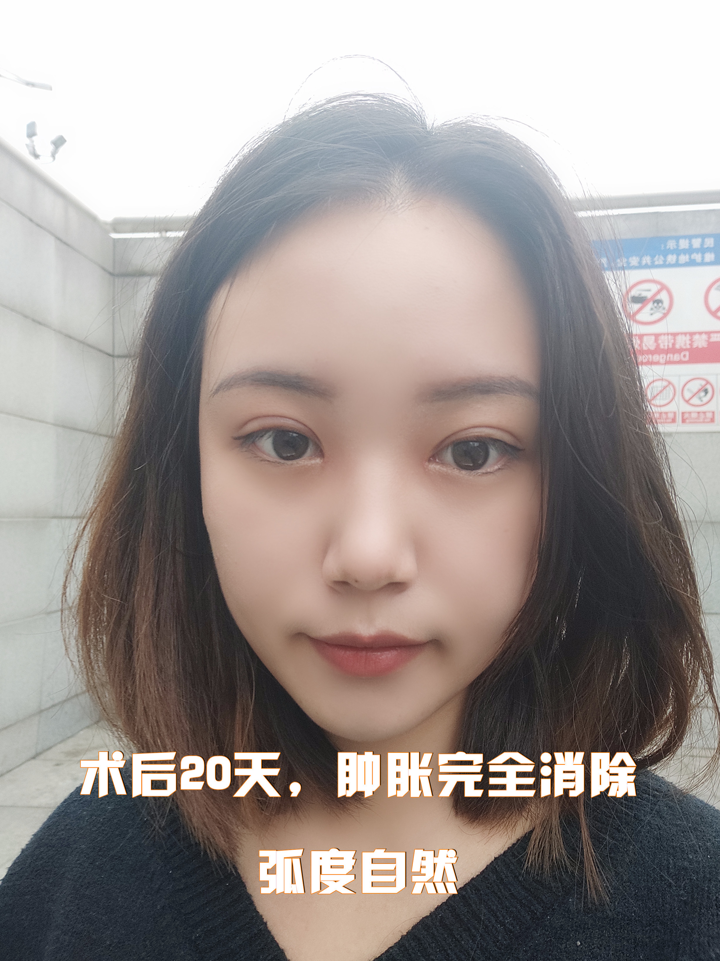 今天给大家分享的是一位来自重庆的姑娘,姑娘天生单眼_圈子-新氧美容
