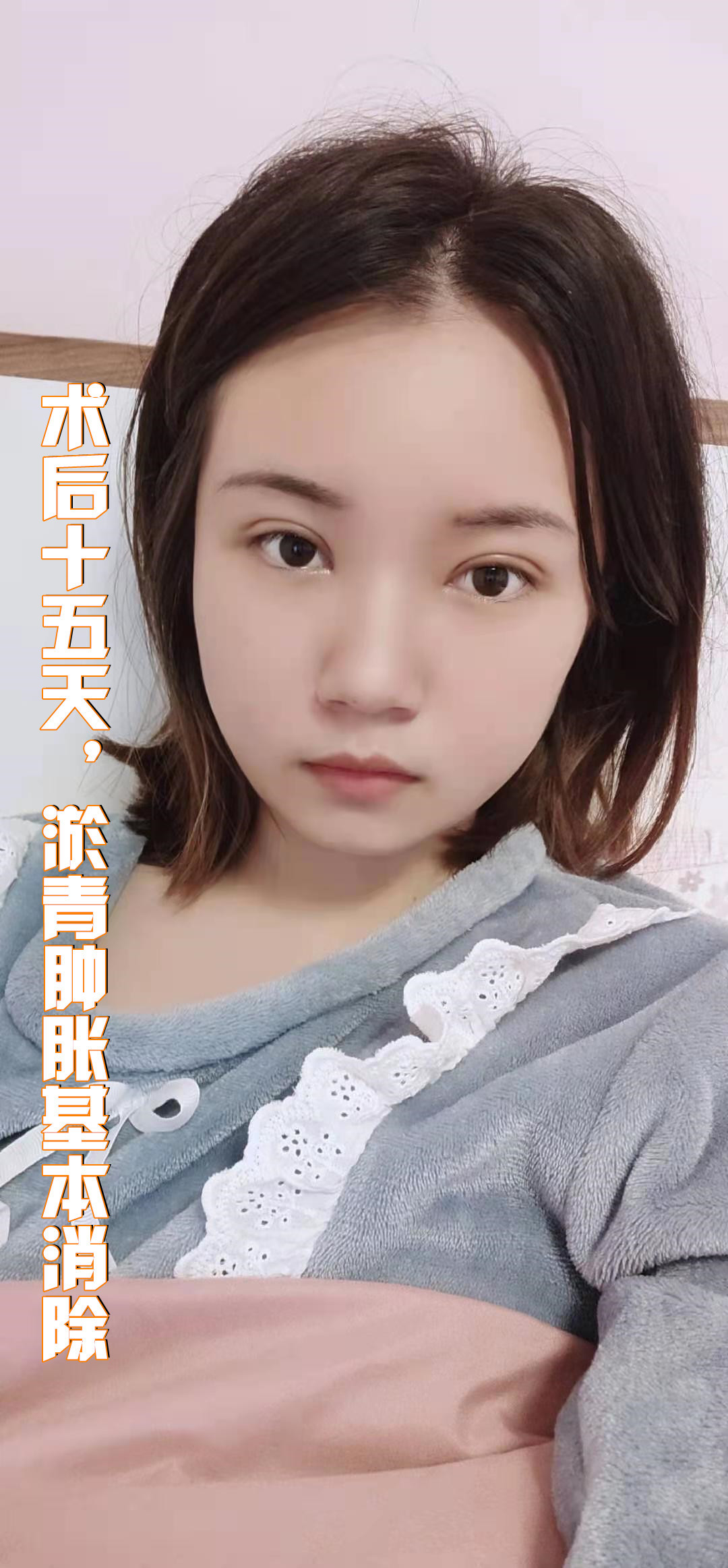 今天给大家分享的是一位来自重庆的姑娘,姑娘天生单眼_圈子-新氧美容