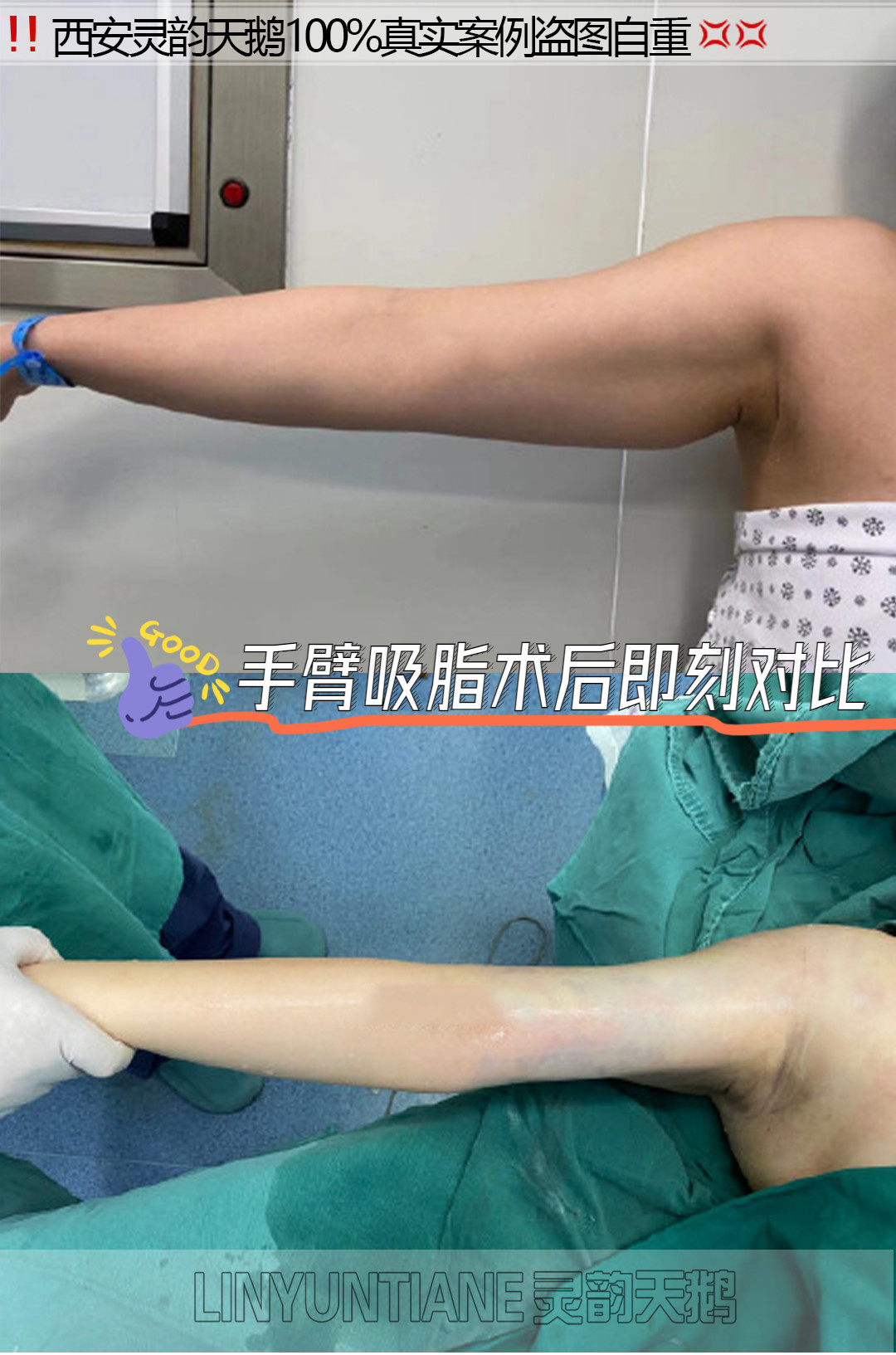 手臂吸脂术后对比