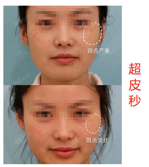 医美避雷超皮秒比皮秒多了一个超所以效果就更好吗