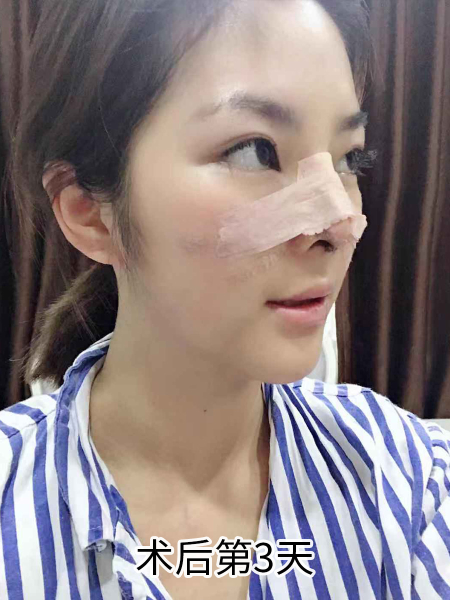 花38w做的妈生款美鼻曝光