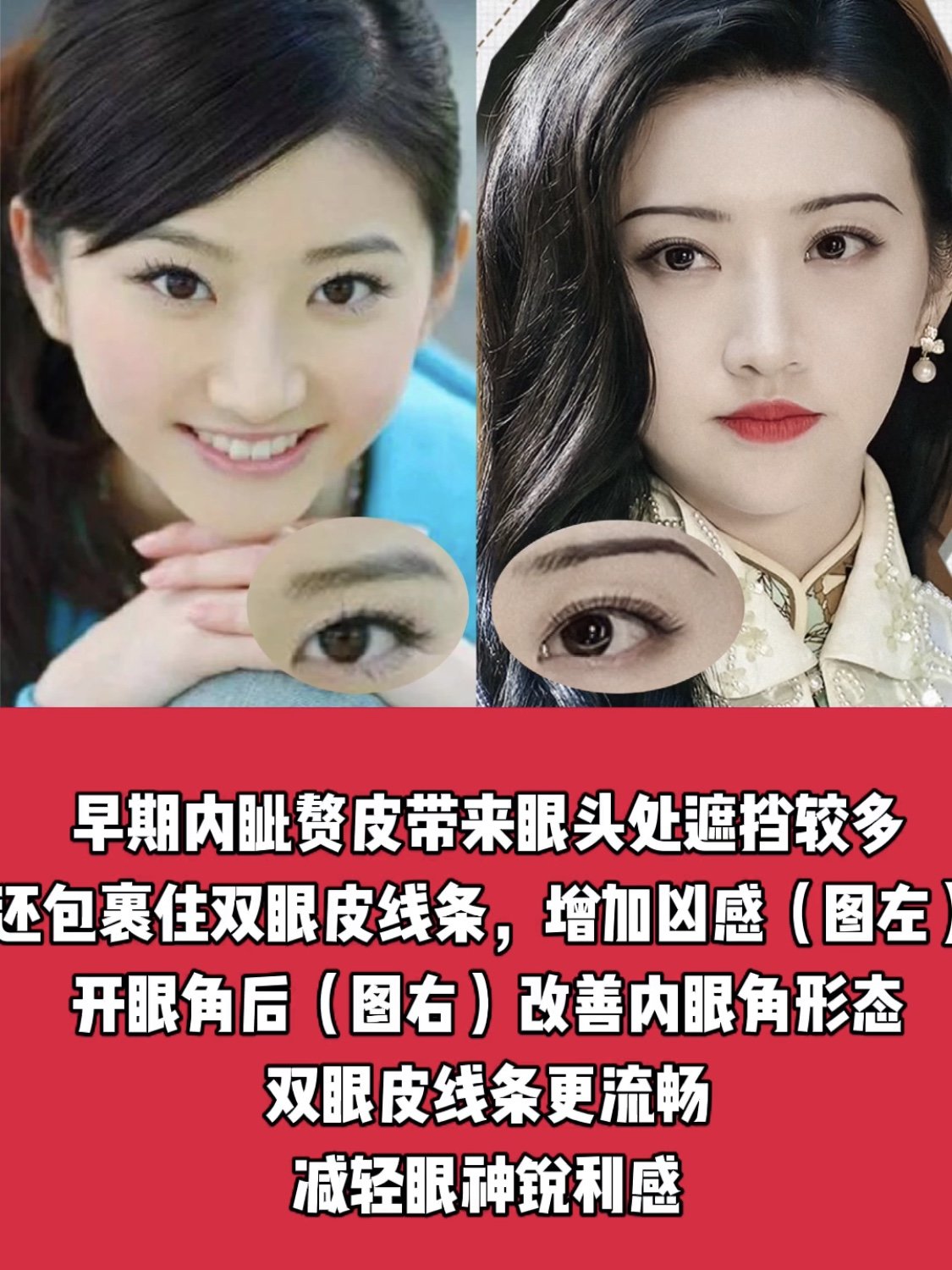 没有了青蛙眼的景甜新角色美到爆,双眼皮宽度应该如何选择?