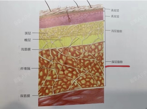 留下紧贴表层皮肤约1厘米厚的浅层脂肪,使局部的脂肪层变得很