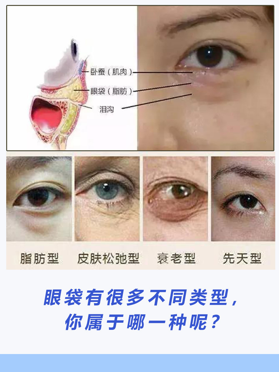 眼袋有很多不同类型你属于哪一种呢