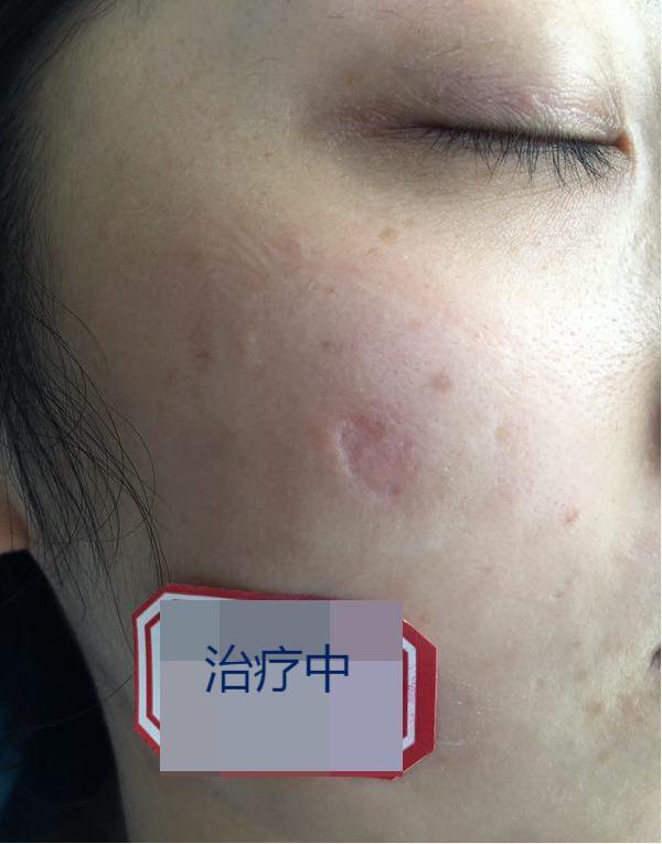 刘女士面颊有一块不规则凹陷色脱疤痕,据她描述,这块