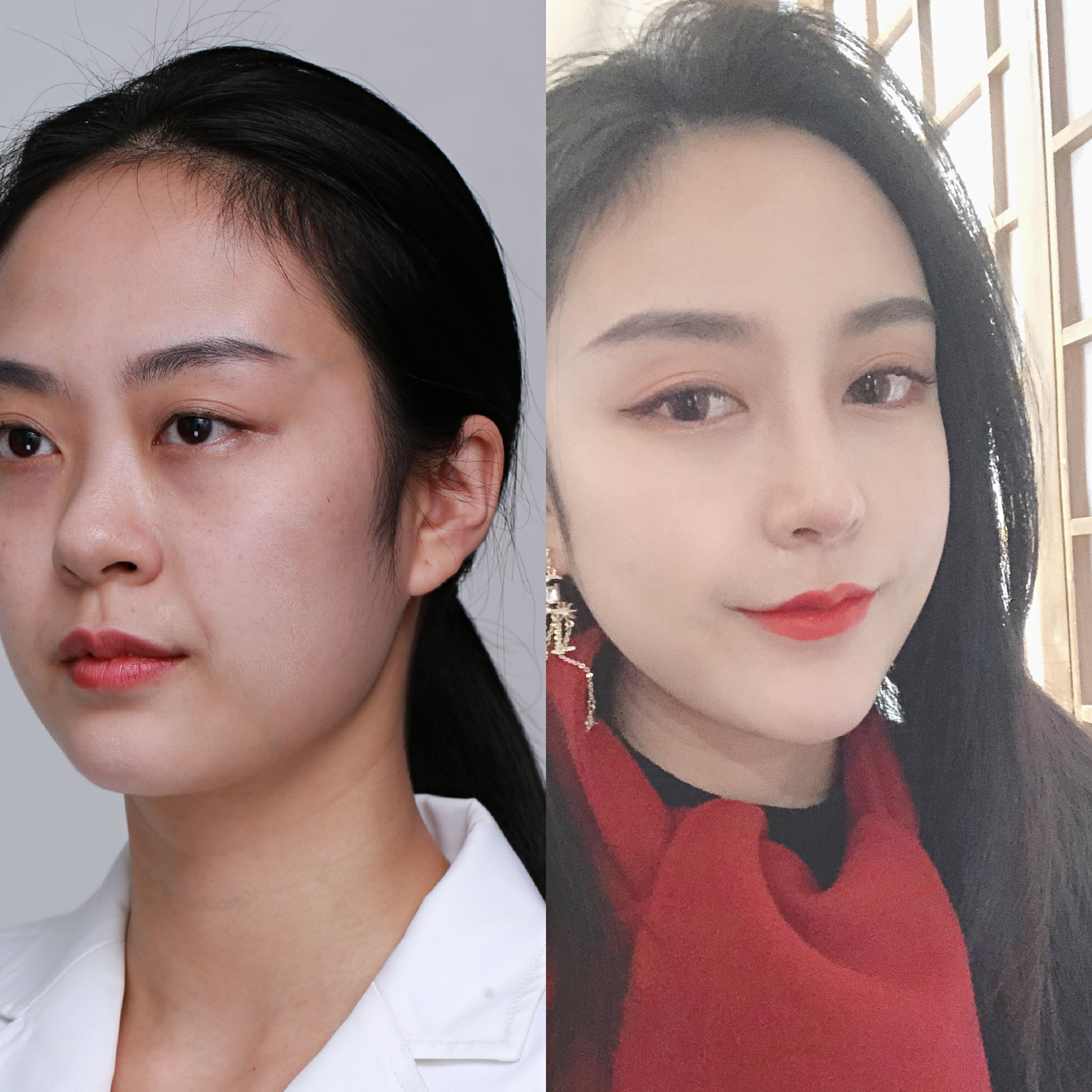 鼻尖支撑和鼻背垫高都