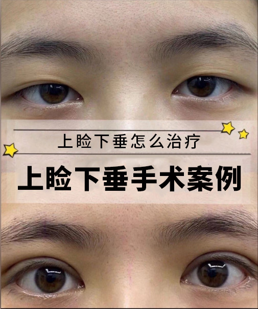 上睑下垂67上睑下垂怎么治疗-上睑下垂手术案例对于_圈子-新氧美容