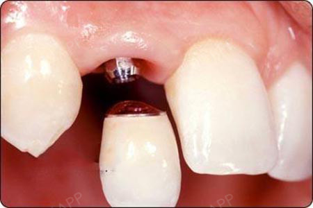 种植牙作为牙科中最难的治疗技术之一,它的成功率是受到多方面影响的.