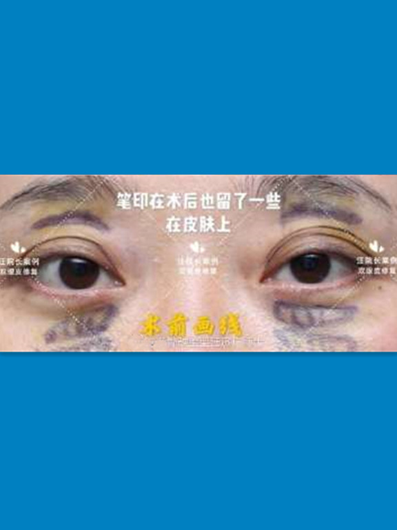 术前求美者眼凸,眼眶凹陷,双眼不对称,多层眼皮.