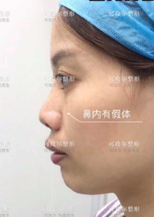 术前做过硅胶隆鼻,出现挛缩反应导致鼻头上旋挛缩,天生鼻小柱软骨发育