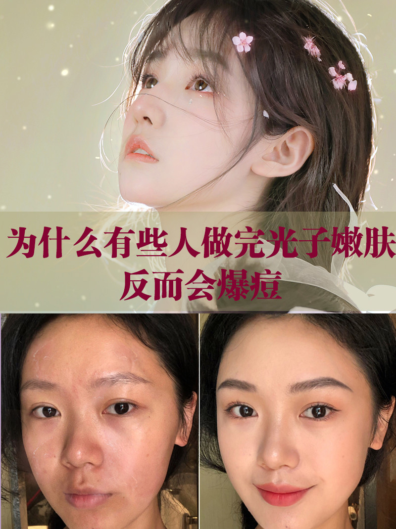 光子嫩肤在去色素,去红等皮肤问题中,都有比较温和的嫩肤效果.