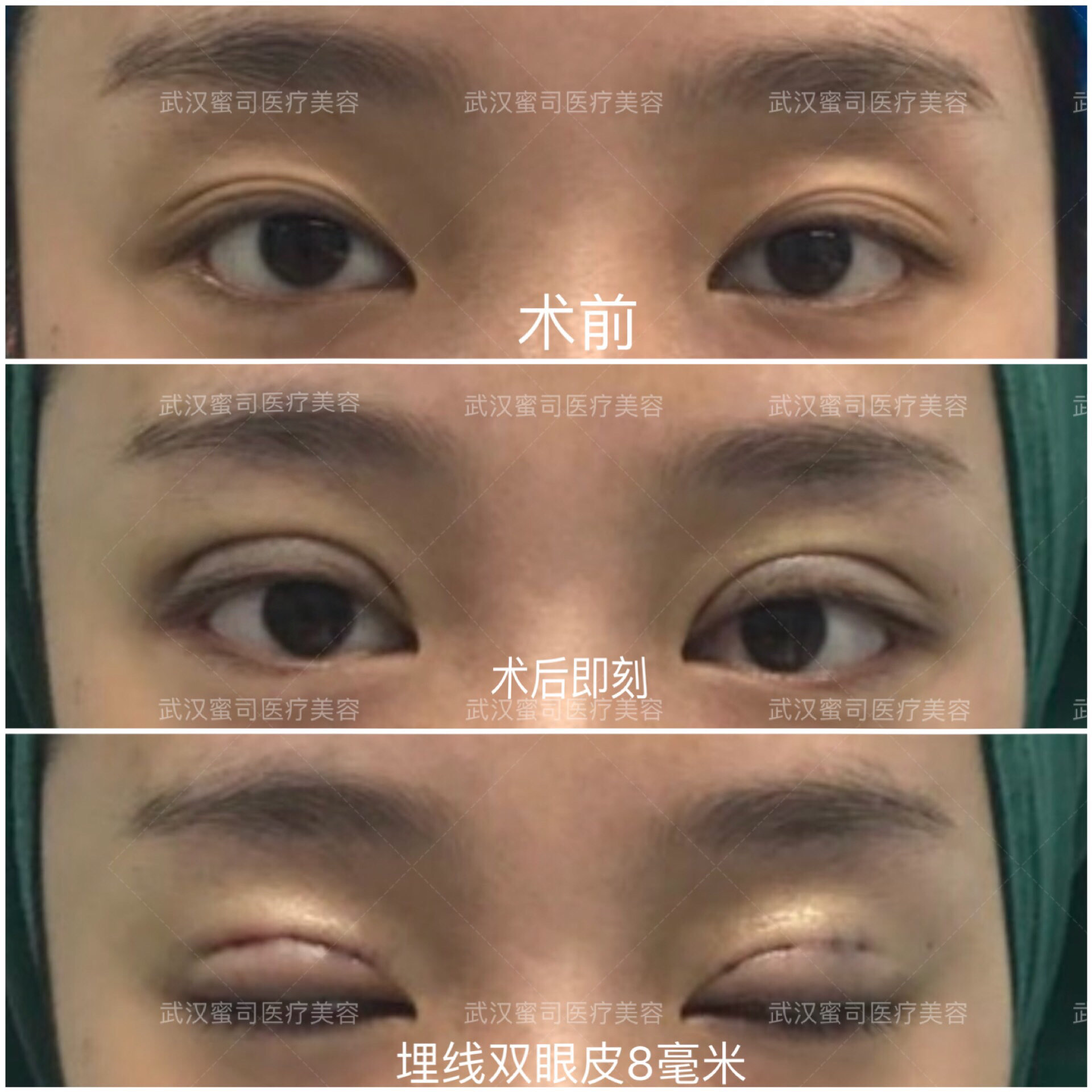 眼皮比较厚,可以考虑做切开双眼皮,如果内双双眼皮的宽度不是特别窄