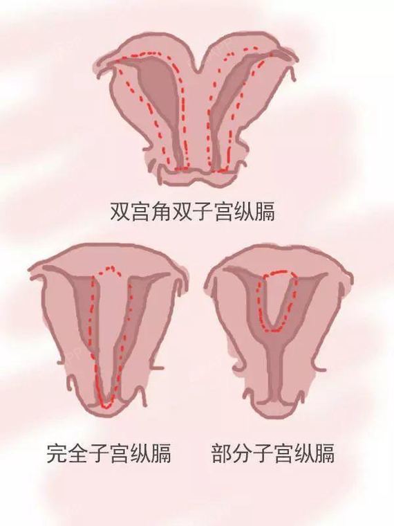 纵膈子宫是指子宫外形正常,但从宫底至宫颈内口或外口有纵膈,根据分隔