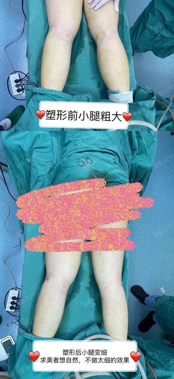 如何判断小腿是脂肪型还是肌肉型?