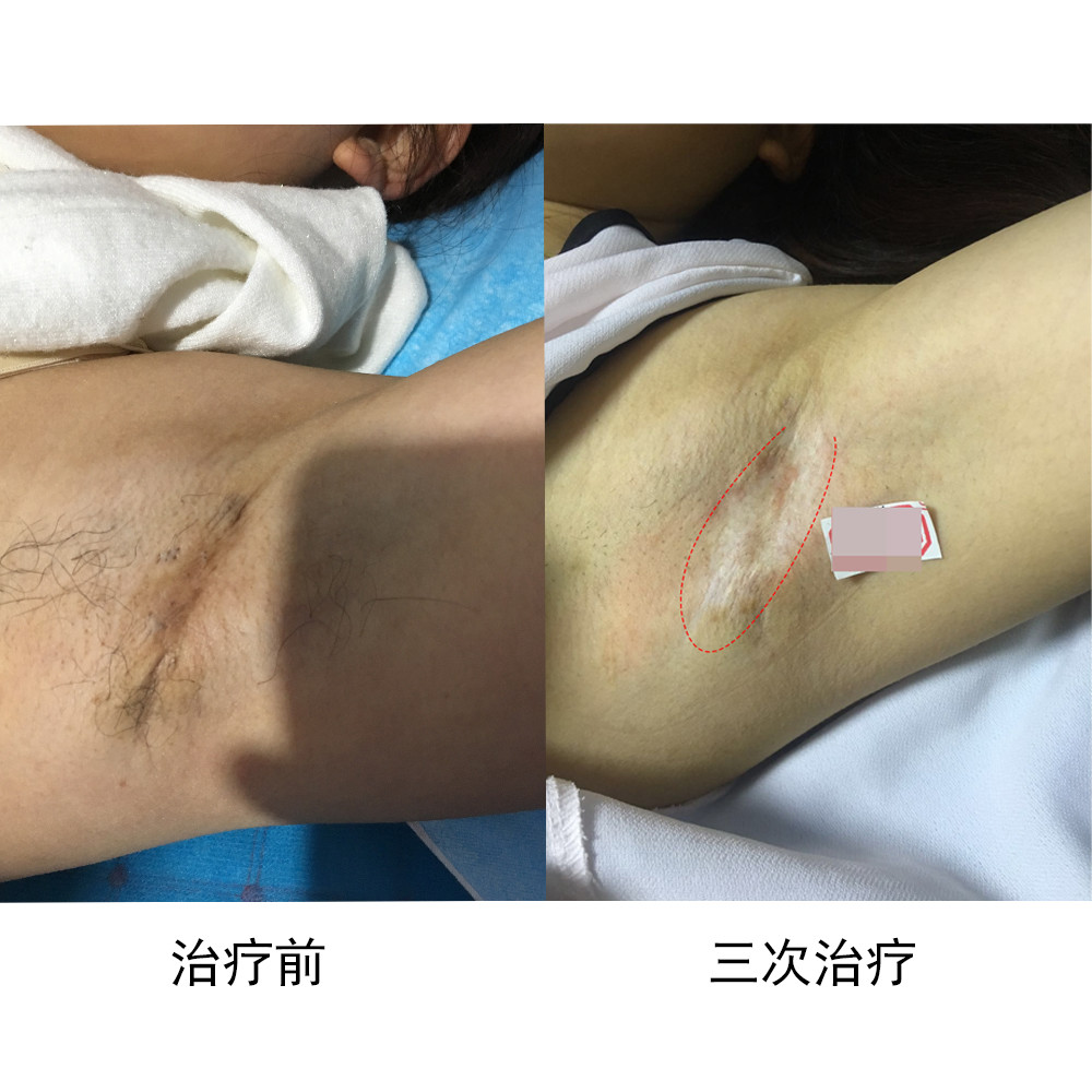 狐臭的问题解决了疤痕的问题又来了
